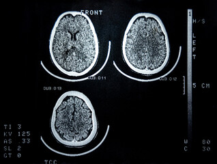 A computed tomography (CT) scan of the human brain, showing three axial slices