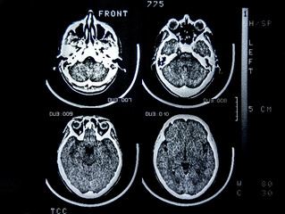 A computed tomography (CT) scan of the human brain, showing three axial slices