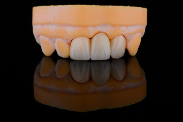 High-quality naturally dental bridge made of zirconium for fixation to frontal teeth of upper jaw. © gorynvd