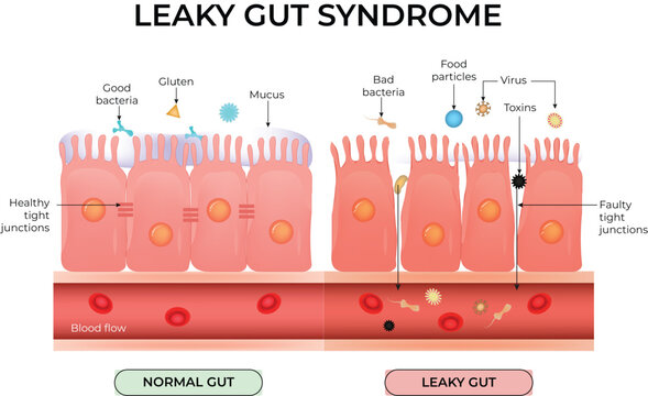 Leaky Gut Syndrome: Visualising Intestinal Permeability and Gut Health