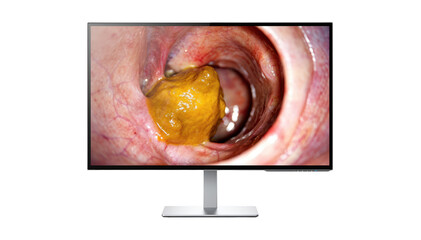 Modern desktop monitor displays AIenhanced otoscope image of ear canal with clear cerumen blockage highlighted against clinical white background.