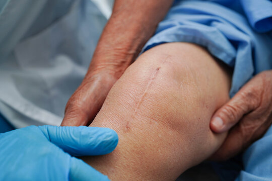 Doctor checking Asian elderly woman patient with scar knee replacement surgery in hospital.
