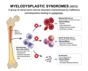 Myelodysplastic Syndromes (MDS) Medical Flashcard