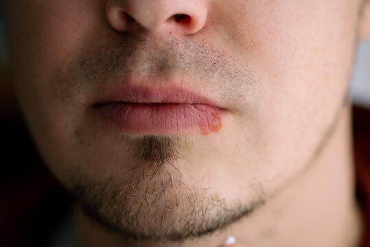Young man having herpes simplex virus outbreak, presenting a cold sore or fever blister on his bottom lip, indicating an infectious inflammatory skin condition requiring dermatology treatment
