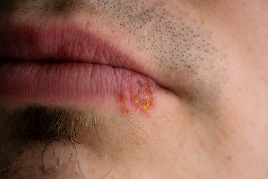 Man experiencing an outbreak of herpes simplex virus type 1. Displaying a developing cold sore blister on the lower part of his lip. Representing a common viral skin condition and dermatological issue