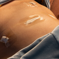 endometriosis surgery 