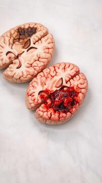 Human brain model anatomy injury stroke brain bleed hemorrhage disease medical education pathology neurology damaged brain organ health surgery research biology science tissue diagnosis comparison