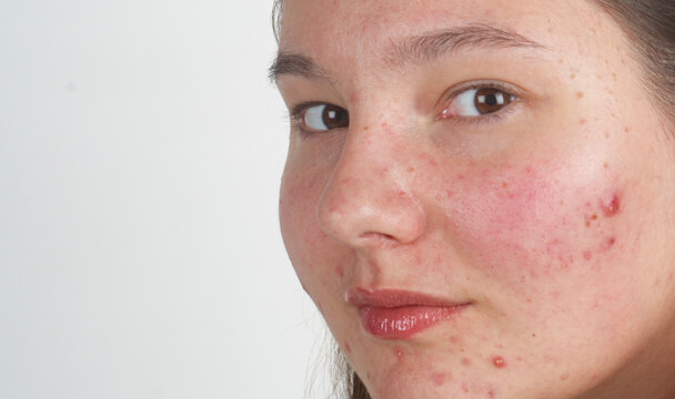 Pimple acne on young woman face close up. Pimple sebum macro. Pimple treatment concept. Acne on female skin. Acne pores texture on skin closeup.. Acne pimple detail.