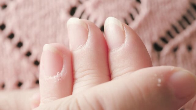 hangnails on fingers, skin scrap, area of ​​exfoliated epidermis surrounding nail, Compulsive nail and cuticle biting, Stress relief or self-harm, obsessive-compulsive disorder, mental health