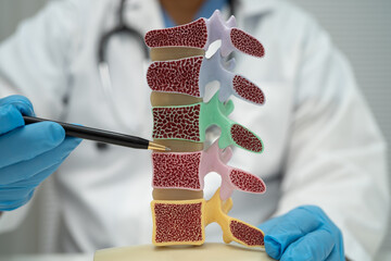 Doctor holding osteoporosis in back bone model for treatment medical.