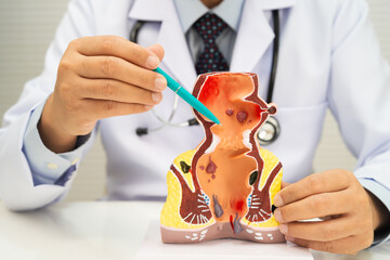 Asian doctor with rectum and hemorrhoid human model, inflamed vascular structure.