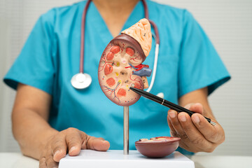 Chronic kidney disease, doctor with model for treatment urinary system, urology, Estimated glomerular filtration rate eGFR.
