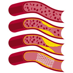 blocked blood vessel vector drawing.