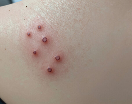 A cluster of reddish, inflamed vesicles with distinct dark, central cores appears on pale human skin.