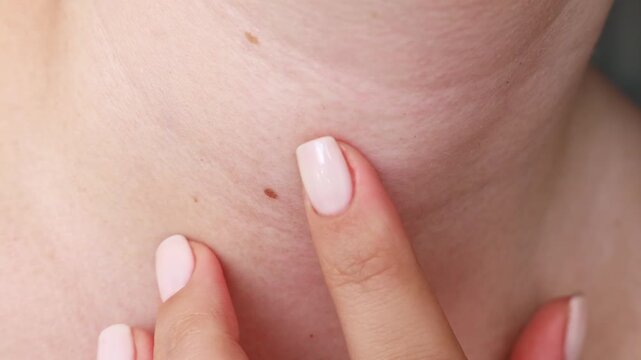 Female skin with birthmark (mole or nevus) touching by finger