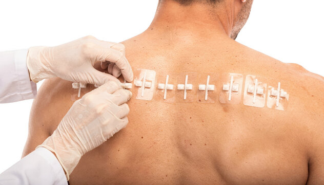 Closeup of a dermatologists gloved hands applying hypoallergenic patch test allergen strips on a male patients upper back against a clean white background.