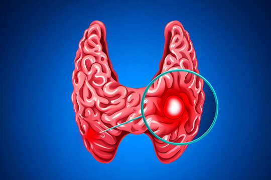 Throat cancer tumor Pink thyroid gland with red inflammation and magnified nodule