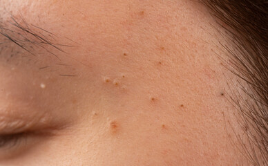 Fototapeta premium Acne close up on forehead skin with pimple and pores texture. Skin detail with comedone whitehead. Acne blemish and pores for dermatology. Close up skin problem with sebum and acne.