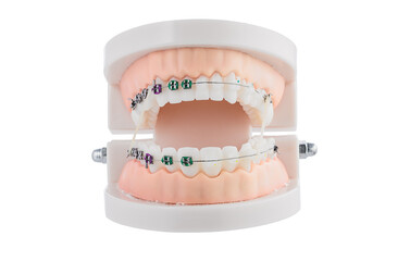 Dental Orthodontic Model With Braces Demonstrating Brackets, Wire, and Alignment for Study