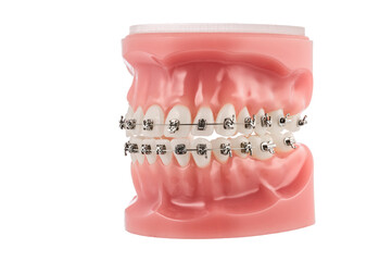 Dental Orthodontic Model With Braces Demonstrating Brackets, Wire, and Alignment for Study