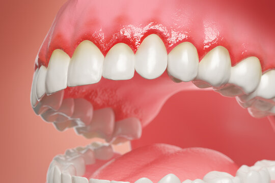 3d illustration of teeth and oral health showing gum disease and inflammation.