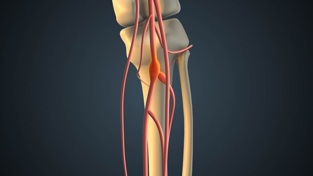 Saccular aneurysm of femoral artery in lower limb