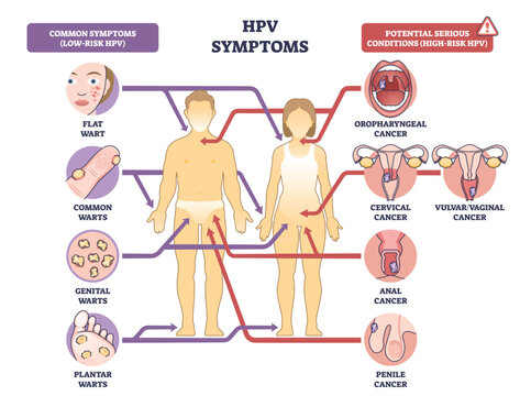 HPV symptoms diagram shows male and female silhouettes with arrows linking warts and cancer sites, key objects, human bodies, wart icons, reproductive organs. Outline diagram