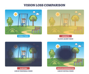 Vision loss diagram compares normal sight, cataracts, glaucoma, macular degeneration using a playground scene with swing, trees, bench. Outline diagram