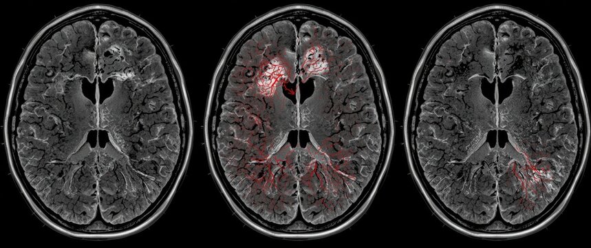 Using brain X-ray images to identify cerebrovascular disease or hemorrhagic stroke