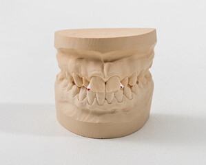 Plaster dental jaw model showing orthodontic bite analysis