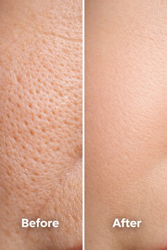 Skin aging vs after collagen boost close up female cheek pore before after comparison smooth texture skincare result pore refine treatment glow youthful repair healthy change concept facial