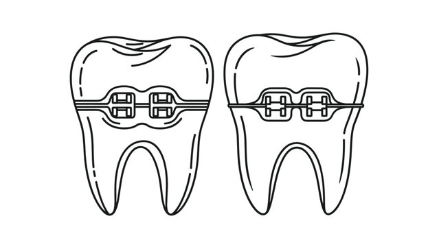 Close up black and white line art illustration of two teeth with dental braces showing the brackets and archwire for alignment.