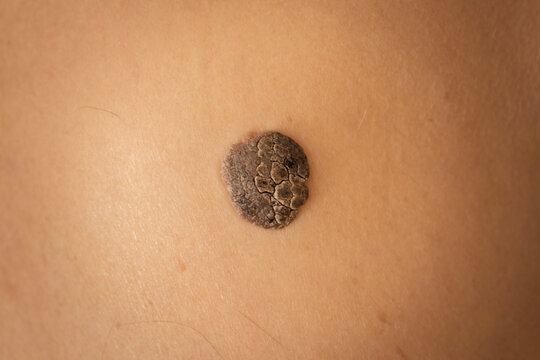 Pigmented skin lesion developing on human skin, resembling a seborrheic keratosis, requiring urgent dermatological evaluation for potential malignancy and early detection