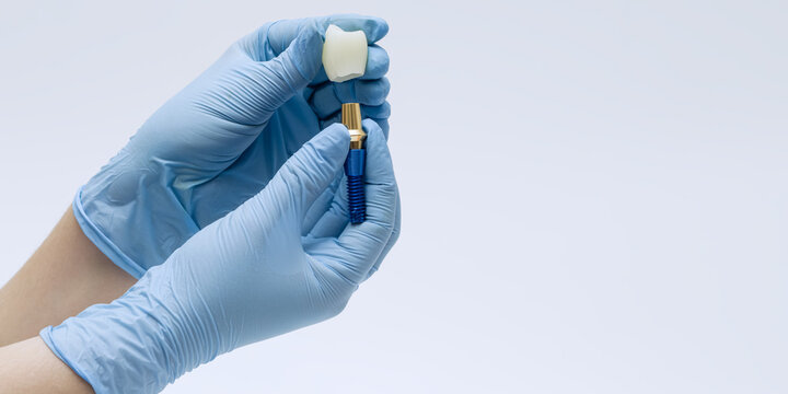 Hands holding dental implant model with crown and abutment