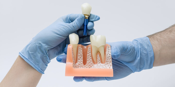 Gloved hands holding a dental implant and anatomical jaw model, illustrating tooth replacement procedure in professional dental practice.