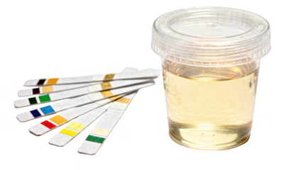 Closeup of ketone test strips and urine sample cup isolated on white background highlighting essential tools for community health urine testing workshops.