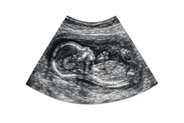 Fetus ultrasound scan showing a developing baby in the womb, representing new life, healthcare, and prenatal care with transparent background