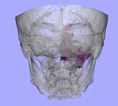 3D CT scan of the paranasal sinuses showing sinus cavities, nasal septum, and facial bones with findings suggestive of sinusitis, nasal polyps, or mass lesions for radiology and ENT evaluation