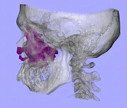 3D CT scan of the paranasal sinuses showing sinus cavities, nasal septum, and facial bones with findings suggestive of sinusitis, nasal polyps, or mass lesions for radiology and ENT evaluation