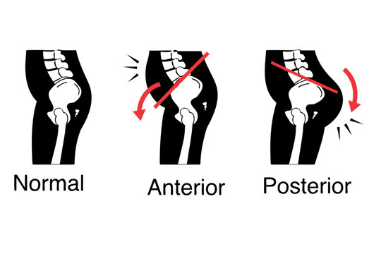 Anterior and Posterior Pelvic Tilt Posture Comparison Black Silhouette