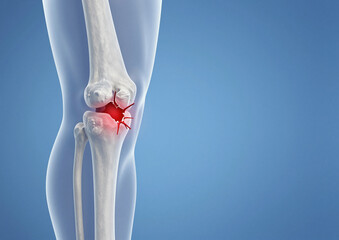 This 3D medical depiction illustrates a severe comminuted fracture or trauma within the human knee joint, emphasized by glowing red.