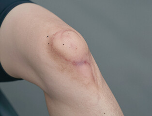 A close-up view captures a pale knee joint displaying circular bruising around the kneecap and a small, healing scar.