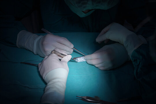 Surgeon preparing Physician Modified Endovascular Graft (PMEG) using an aortic stent graft in operating room.