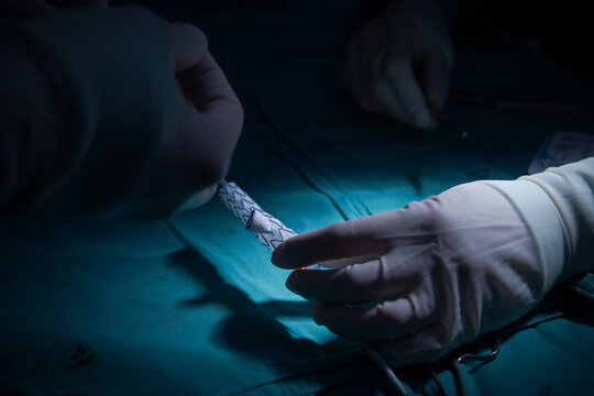 Preparation of Physician Modified Endovascular Graft (PMEG) on surgical table.