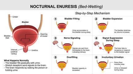 Nocturnal Enuresis - Bed-Wetting Medical Flashcard