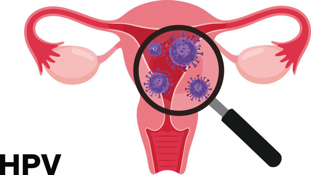 HPV infection illustration, female reproductive system diagram, cervical virus magnification, medical awareness graphic, health education concept, flat vector illustration