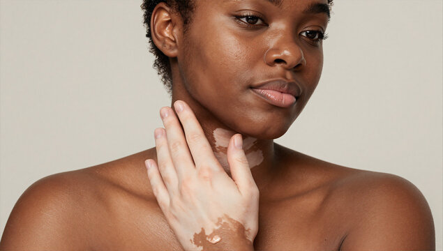 Vitiligo Skin Condition Woman Applying Barrier Cream Body Positivity Beauty