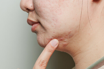 Real young woman's face with acne scars, blemishes and oily skin texture, dermatology and skincare...