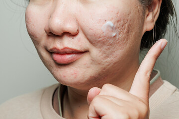 Obraz premium Real young woman's face with acne scars, blemishes and oily skin texture, dermatology and skincare concept.