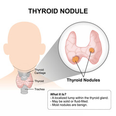 Thyroid Nodule, ENT Medical Flashcard